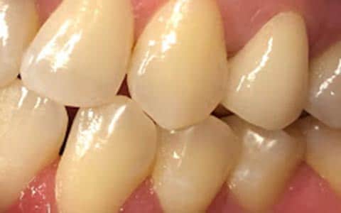 Home Remedies for Gum Infection