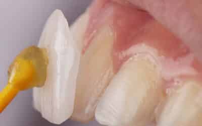 Patients In Garland, TX Get Years Of Beautiful Smiles By Caring For Dental Veneers Properly