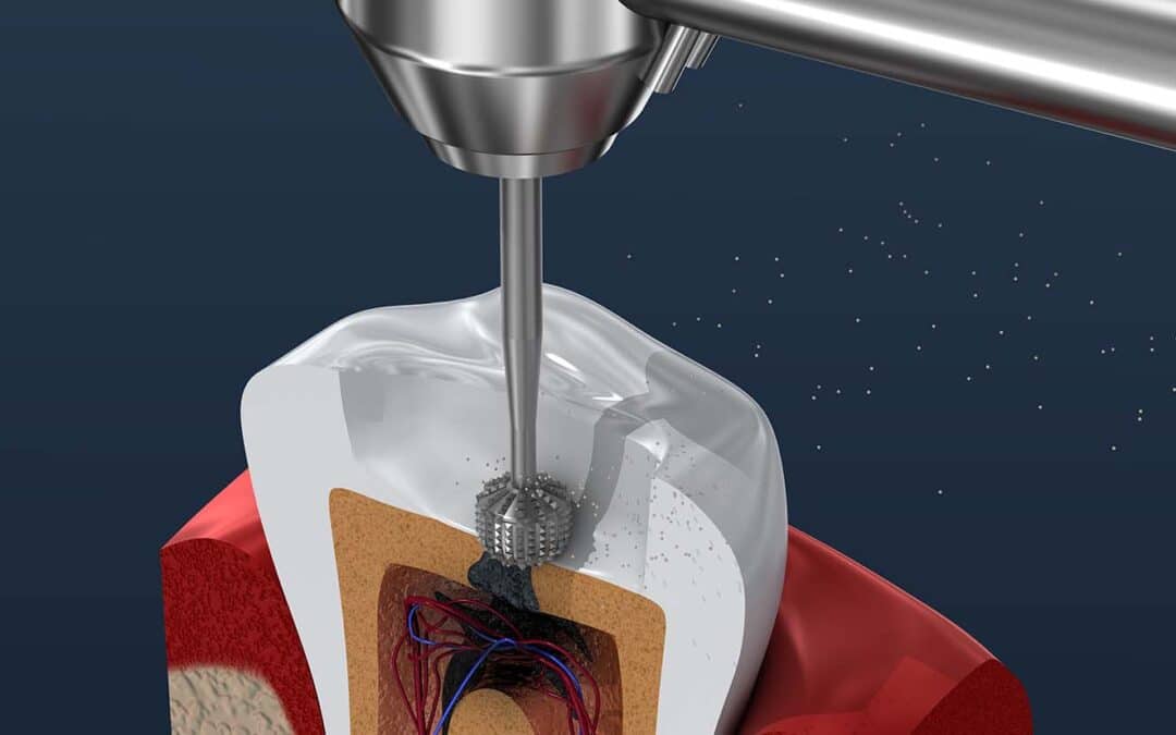 Dentist Near Richardson Dispels Myths And Explains The Benefits Of Root Canal Treatment