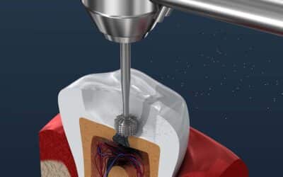 Dentist Near Richardson Dispels Myths And Explains The Benefits Of Root Canal Treatment