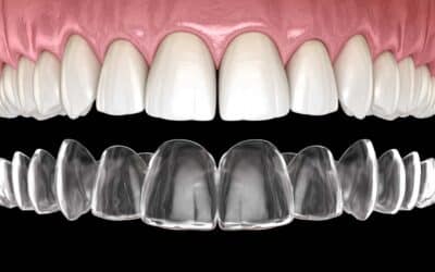 Why The Invisalign Satisfaction Rate For Patients In Garland TX Is High