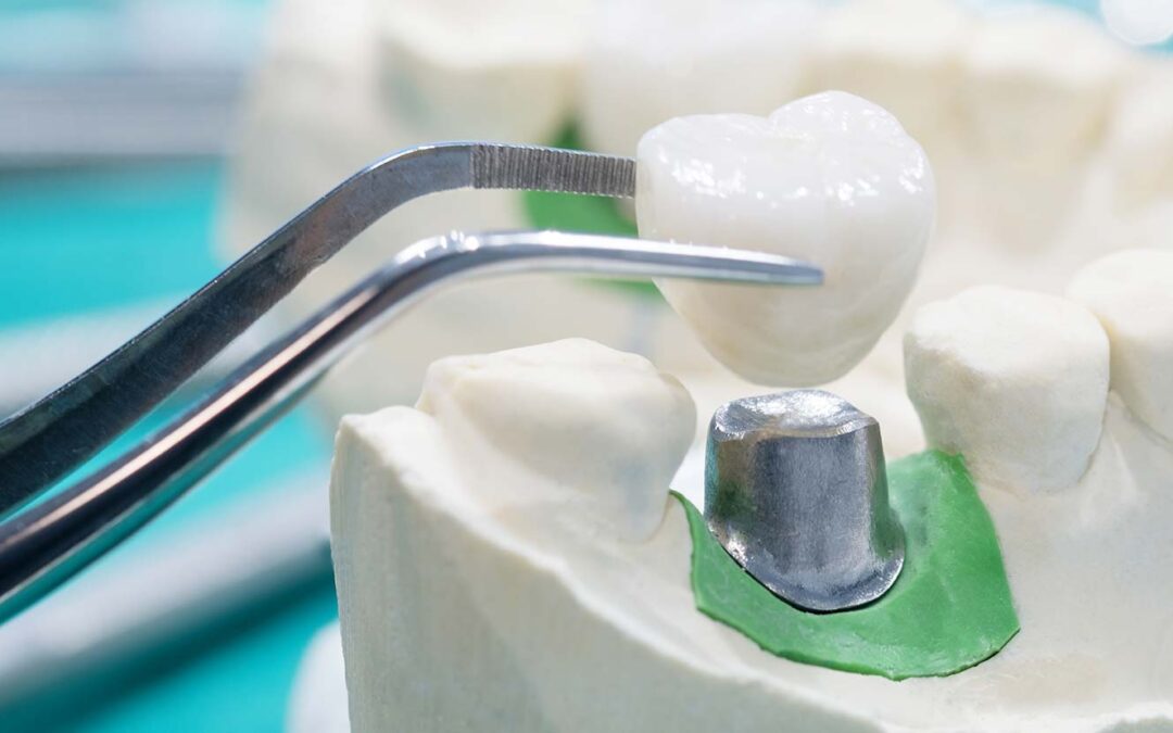 Broken or Cracked Teeth Treatment In Garland, TX