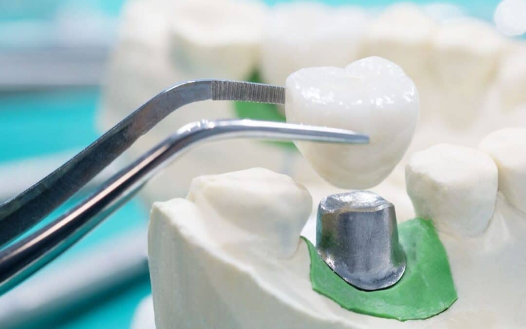 Problems You Can Fix With Dental Crowns and Bridges In Garland, Tx