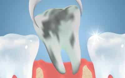 A Beginner’s Guide to Wisdom Teeth Extraction Preparation In Garland, TX